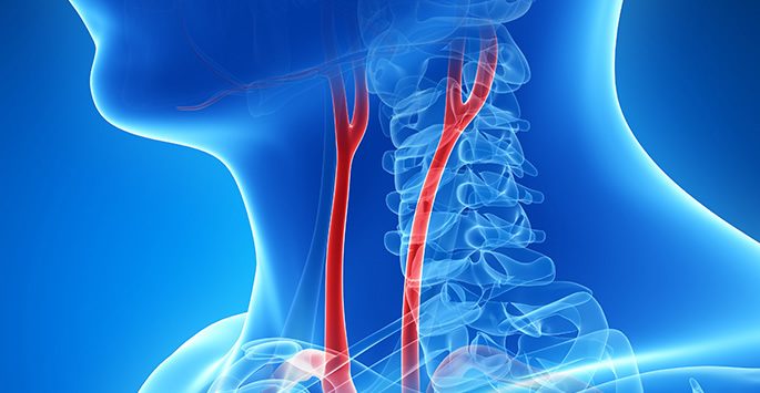 carotid-artery-surgery-carotid-artery-doctors-in-san-antonio