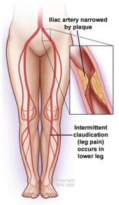 Leg Pain Symptoms - Peripheral Vascular Associates