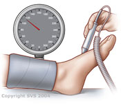 Ankle-Brachial Index (ABI) - Peripheral Vascular Associates