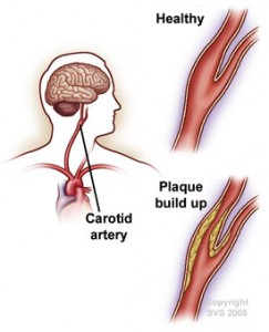 Carotid artery disease - Peripheral Vascular Associates