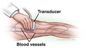 Doppler Ultrasound - Peripheral Vascular Associates