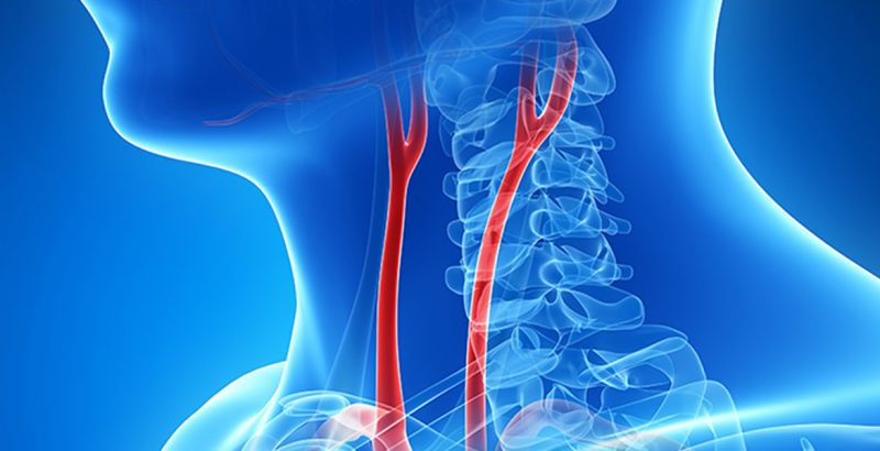 Carotid Artery Surgery - Peripheral Vascular Associates