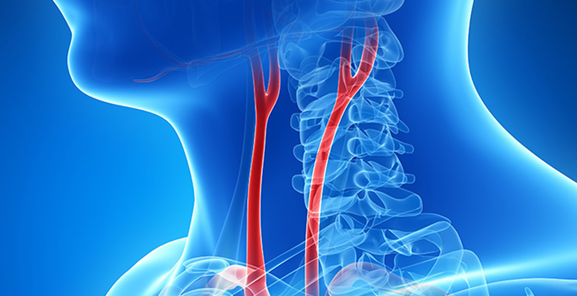 Carotid Artery Surgery Carotid Artery Doctors In San Antonio