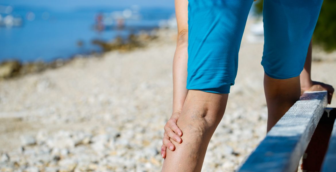 Dealing with Varicose Veins this Summer - Peripheral Vascular Associates