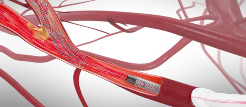 PVA One of the First to Offer Innovative TCAR Procedure - Peripheral Vascular Associates