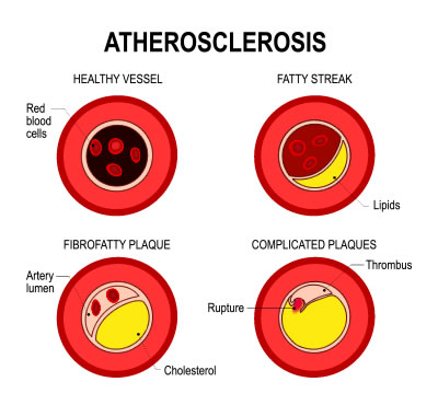 Atherosclerosis in Diabetic Patients | PVA San Antonio