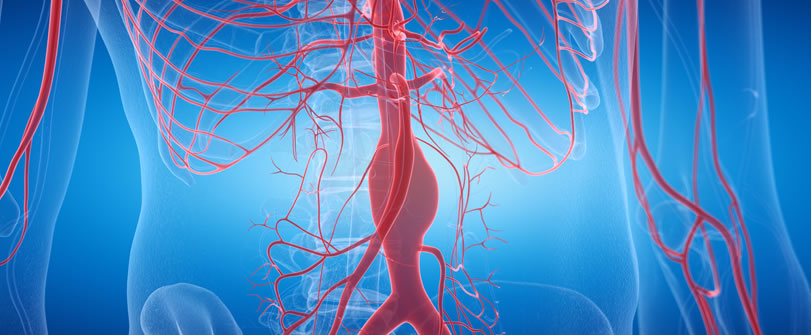 Lifesaving Screening can Help Detect the Silent Killer - Peripheral Vascular Associates