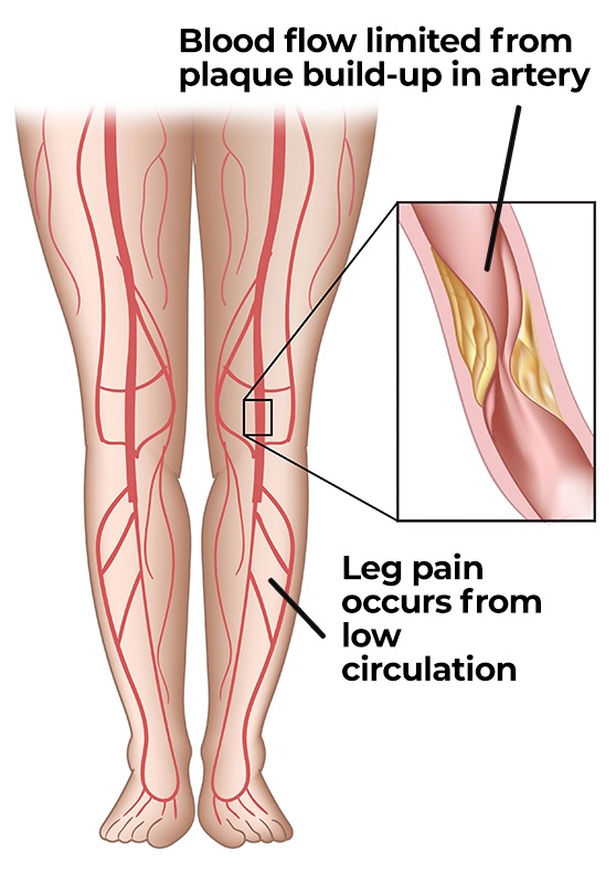 Plaque buildup limits blood flow and circulation