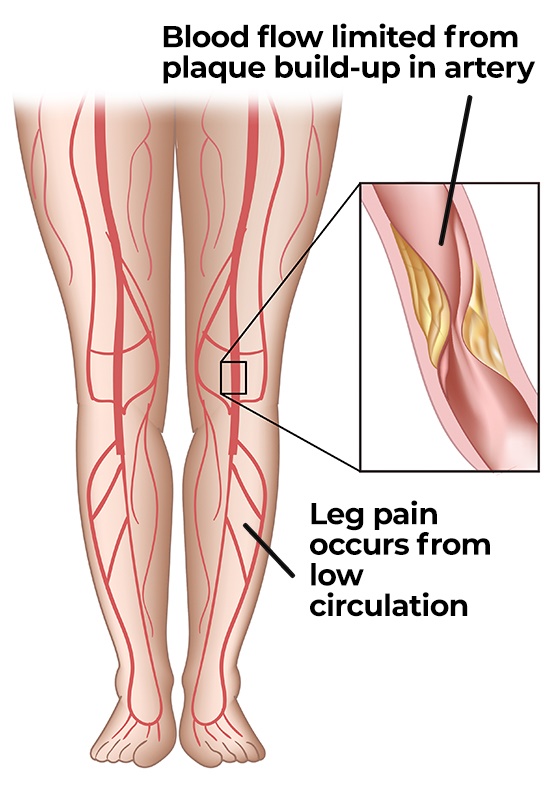 Blood circulation in legs