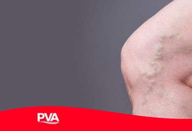 Varicose veins: What are they? - Periperal Vascular Associates