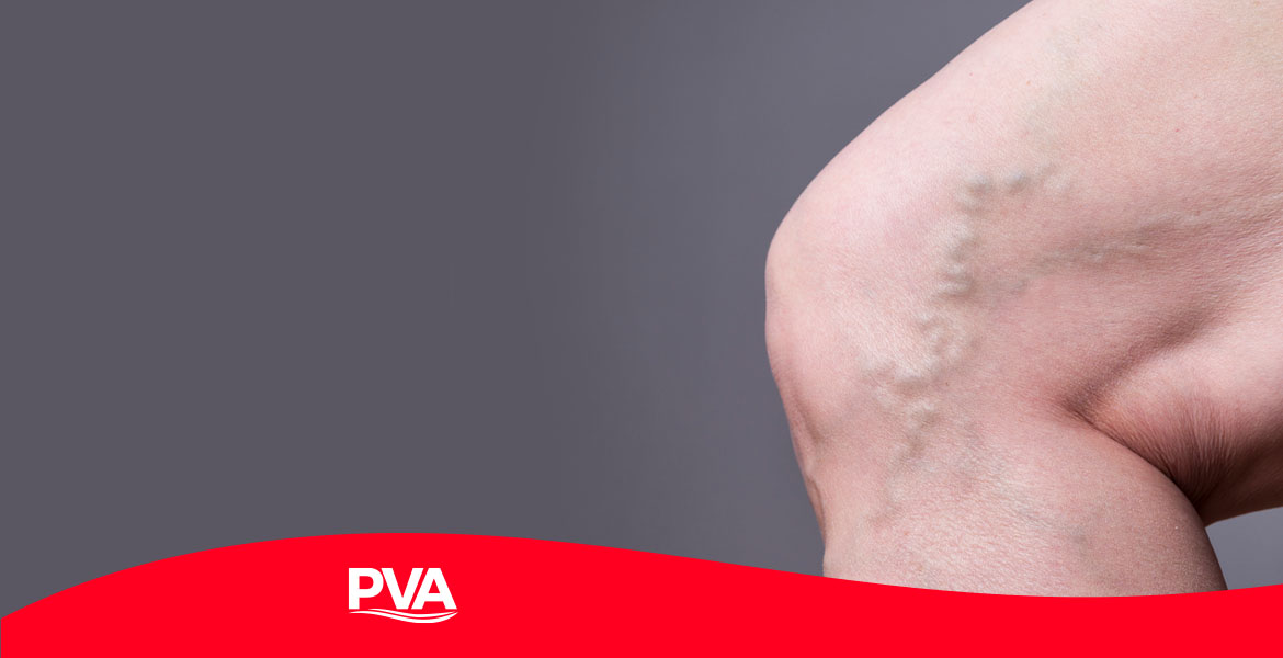 Varicose veins: What are they? - Peripheral Vascular Associates